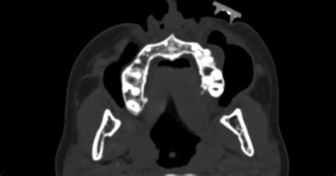 Periapical Abscess Image