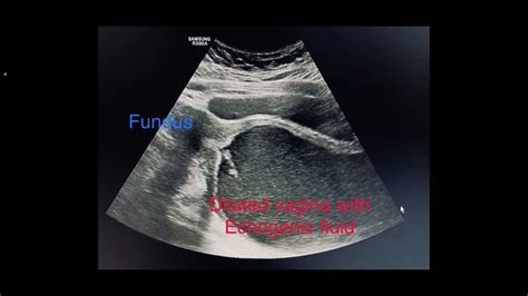 Classic Case Of Imperforate Hymen With Hematocolpos Youtube