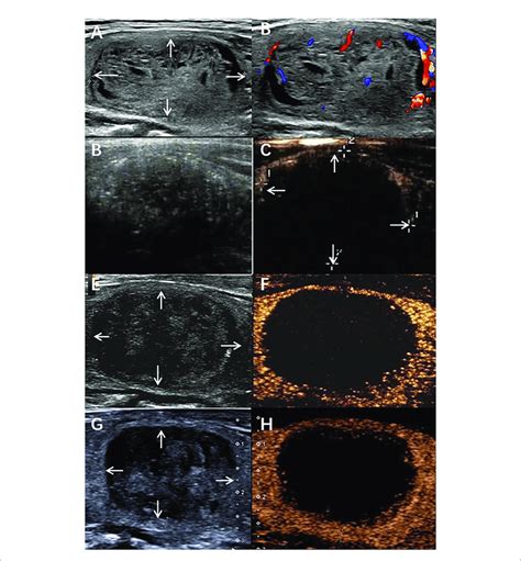 A Benign Thyroid Nodule In A 58 Year Old Male Treated With