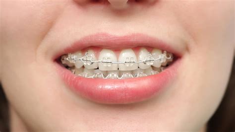 ¿conoces Los Diferentes Tipos De Brackets Clínica Faus