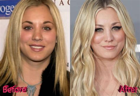 Kaley Cuoco Plastic Surgery An Example To Follow
