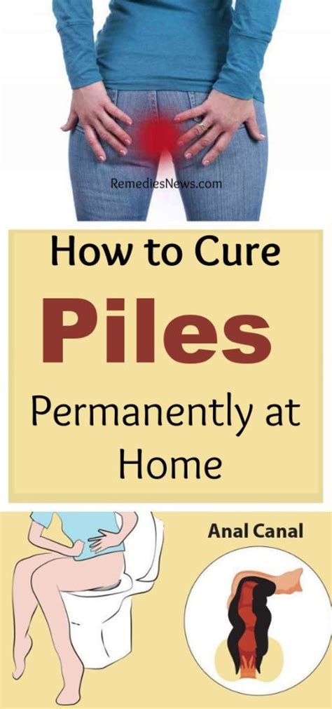 How To Get Rid Hemorrhoids At Home Fast 10 Home Remedies For Piles