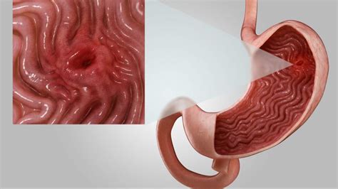 Typically, cancer signs and symptoms first appear when the cancerous tumor or mass has grown large enough that it begins to push against nearby organs and tissue, blood vessels, and nerves. What Is a Stomach Ulcer? Gastroenterologists Explain ...