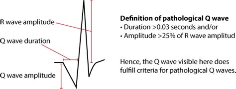 The Qrs Complex Ecg Features Of The Q Wave R Wave S Wave And Duration