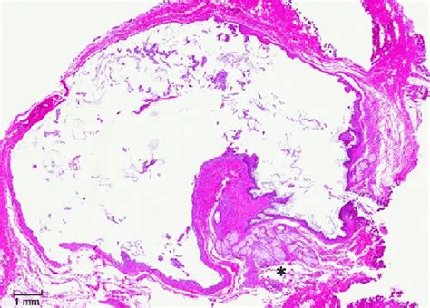 6 Specimen Submitted As Tgd Cyst Shows Typical Histological