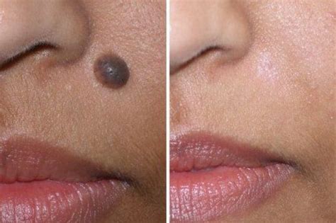 Before And After Mole Removal Pictures Home Remedies Natural Home