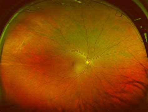 Optomap Retinal Imaging Is Here