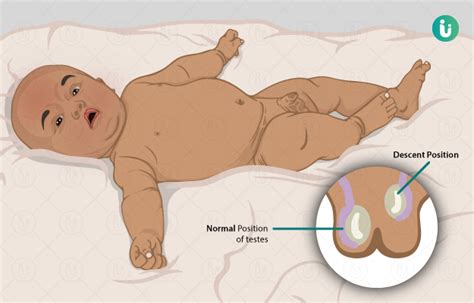 Cryptorchidism Baby