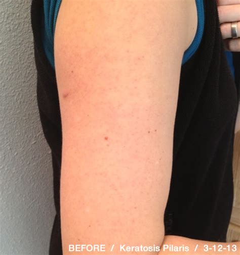 Bumps On Upper Arms