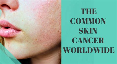 The Most Common Skin Cancer Through Out The World By Episirus Scientifica Medium