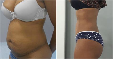Liposuction Photos Before And After With Tips Fitoont