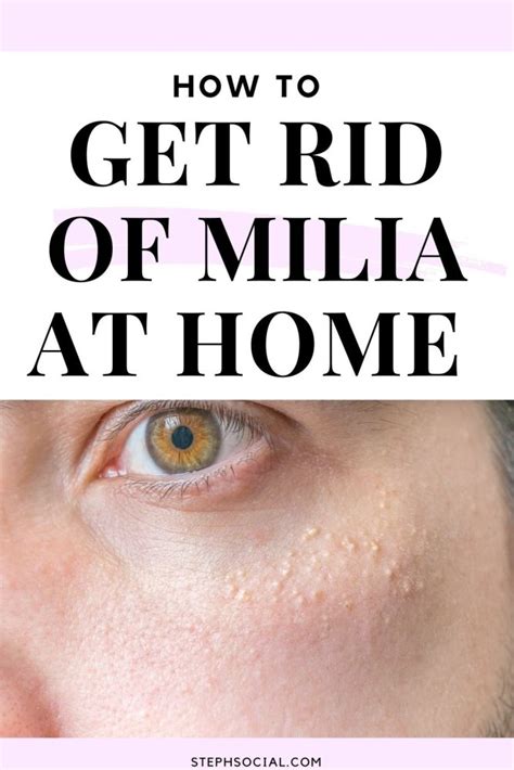 How To Get Rid Of Milia At Home With Tretinoin Steph Social