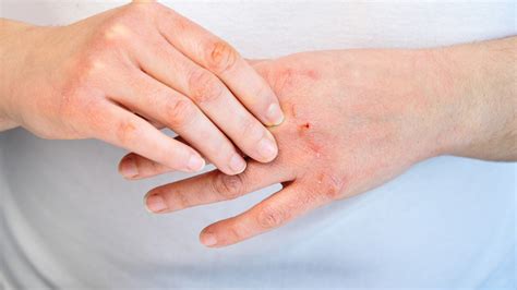 Eczema And Atopic Dermatitis Toronto Dermatology Centre