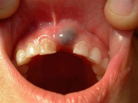 kyste dentaire symptômes – kyste dentaire que faire – Aep22