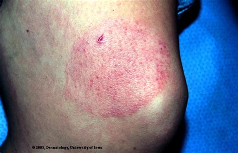 Ringworm Picture From Ui Dermatology Tinea Corporis Hardin Md