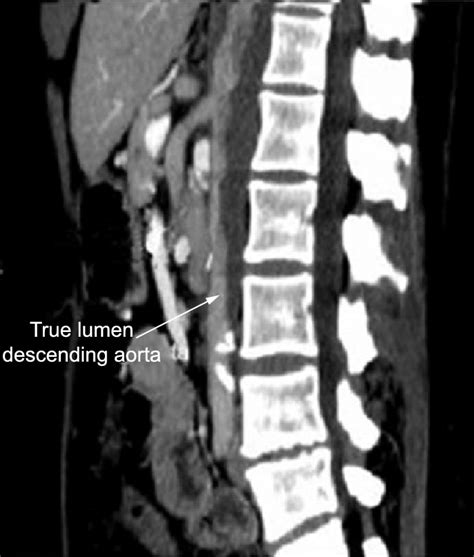 Multidetector Ct Of The Abdomen Sagittal Reformatted Images Of The