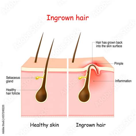 Ingrown Hairs On Men Symptoms Causes And Treatment