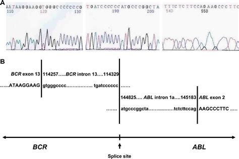 A Unique Bcrabl1 Transcript With The Insertion Of Intronic Sequence From Bcr And Abl1 Genes In