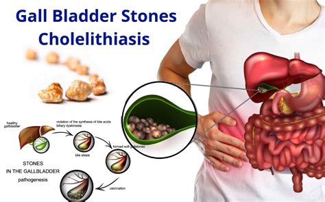 How Is Key Hole Or Laparoscopic Gall Bladder Removal Done Tomar