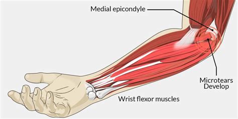 Say Goodbye To Golfers Elbow Effective Exercises And Rehab Tips