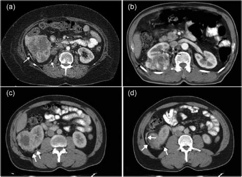 Tumoral Vascular Pattern In Renal Cell Carcinoma And Fat Poor Renal