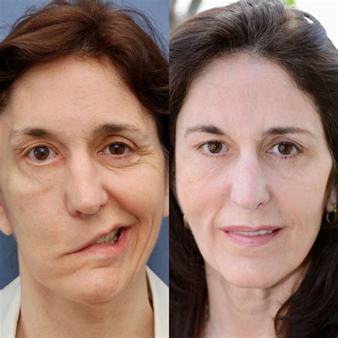Facial Paralysis Center For Advanced Facial Plastic Surgery