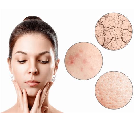 3 Alarming Dry Skin Type Characteristics How To Combat Them