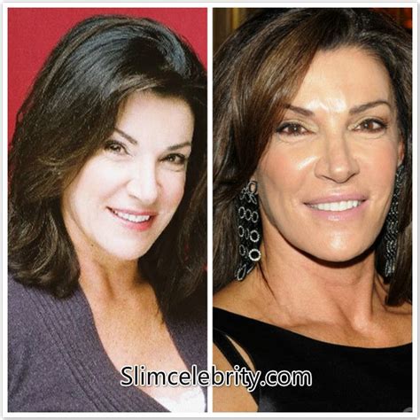 Hilary Farr Plastic Surgery Before And After