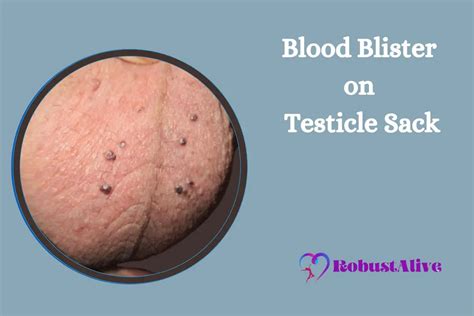 Blood Blister On Testicle Sack Causes Symptoms And Treatment