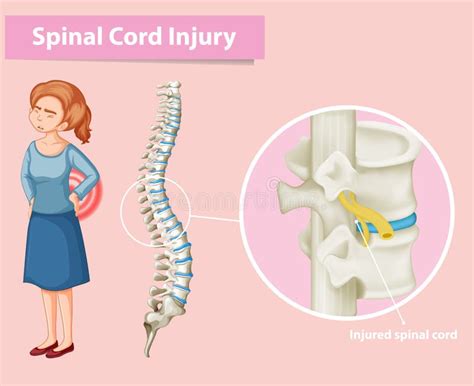 Diagram Showing Spinal Cord Injury In Human Stock Vector Illustration