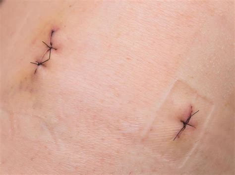 What Is A Resorbable Suture With Pictures