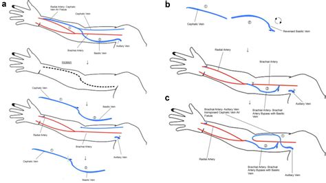 Proximalization Through One Incision Of A Wrist Arteriovenous Fistula