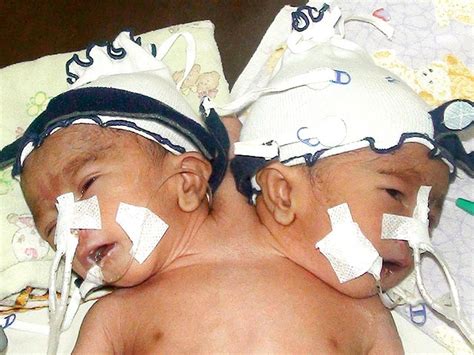 Conjoined Twins 40 Amazing Photos Graphic Images Photo 26