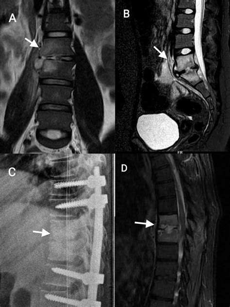 A Coronal Short Tau Inversion Recovery Stir Sequence On Mri Shows