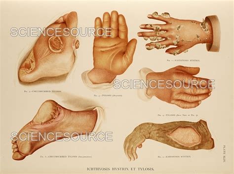Photograph Ichthyosis Hands And Feet Illustrati Science Source Images