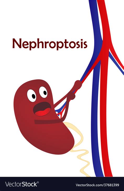 Kidney Disease Nephroptosis One Cartoon Royalty Free Vector