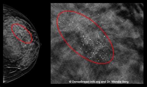 What Do I Need To Know About Mammograms And Dense Breasts Archives