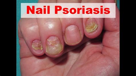 Nail Psoriasis What Exactly Is Nail Psoriasis Youtube
