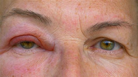 Eye Discharge Causes Associated Conditions And Treatments 1md