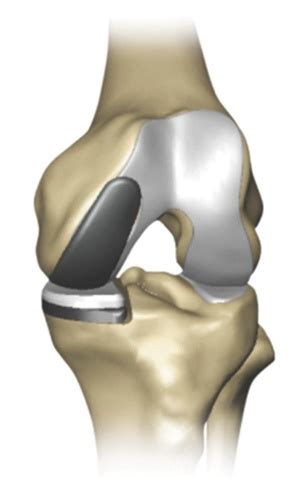 Partial Knee Replacement Physiopedia
