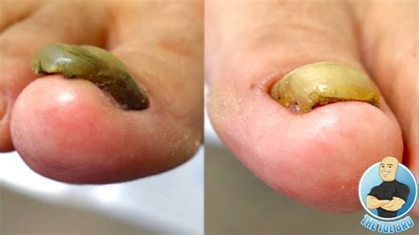 SUPER THICK TOENAIL TRIMMING AND FILING TOENAIL FUNGUS OR DAMAGED