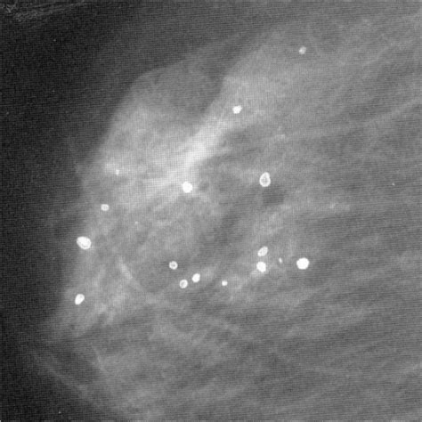 A Mammogram Of Female Breast Revealing Micro Calcifica Open I
