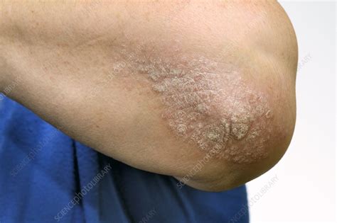 Psoriasis On The Elbow Stock Image C0151665 Science Photo Library