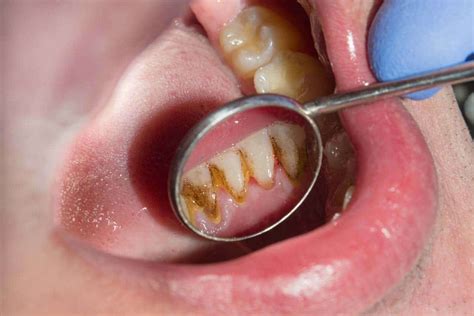 Zahnstein And Zahnbelag Selber Entfernen Methoden And Risiken