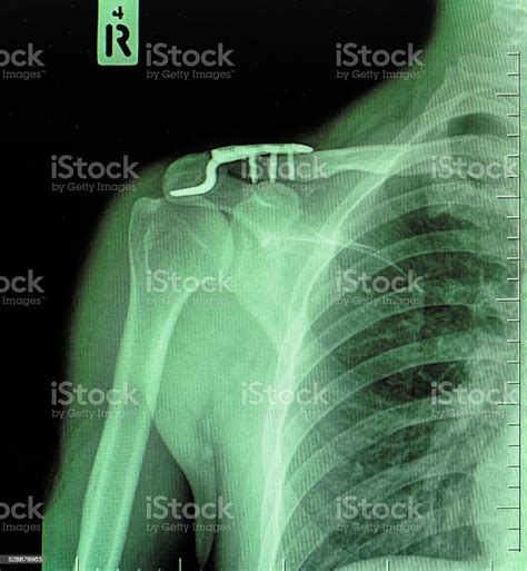 X Ray Of Collarbone Stock Photo Download Image Now Anatomy Blue