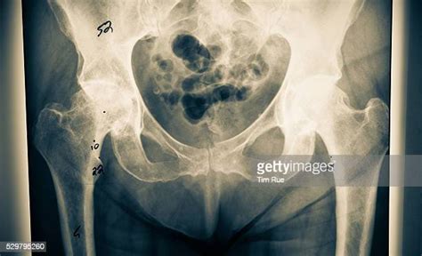 Hip Replacement X Ray ストックフォトと画像 Getty Images