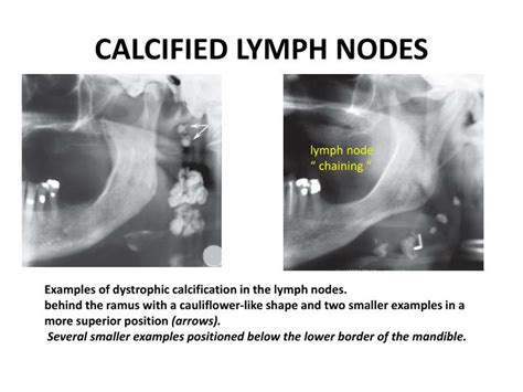 Causes Of Calcified Lymph Nodes