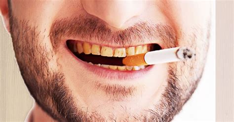 smoking causes yellow teeth get scaling at sabka dentist dental clinic