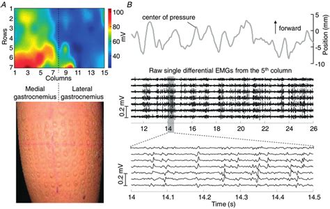 Mapping Electromyograms And Localized Myoelectric Activity A Shows An