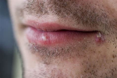 Vitamin B12 Deficiency Sores On The Mouth Known As Angular Cheilitis
